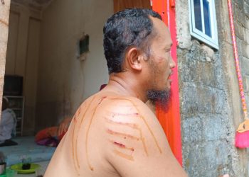 Sugito saat Menunjukan Bekas Gigitan Buaya yang Ia Alami, foto: Mael/detak.media