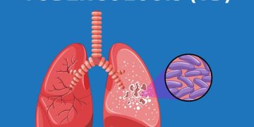 Ilustrasi - TBC. (ANTARA/HO-Kemenkes)